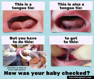 Tongue tie examples