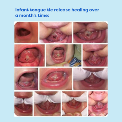 Tongue tie infant pics