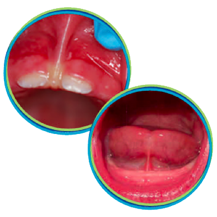 Lip and Tongue Ties